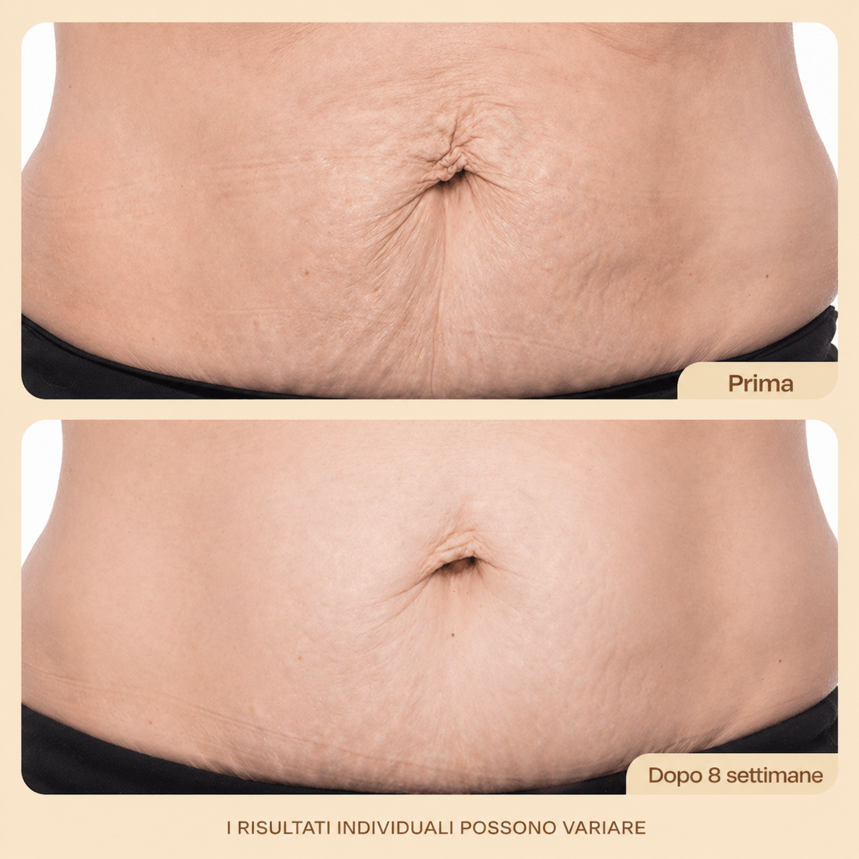 Crema Anti-Smagliature per il Ventre