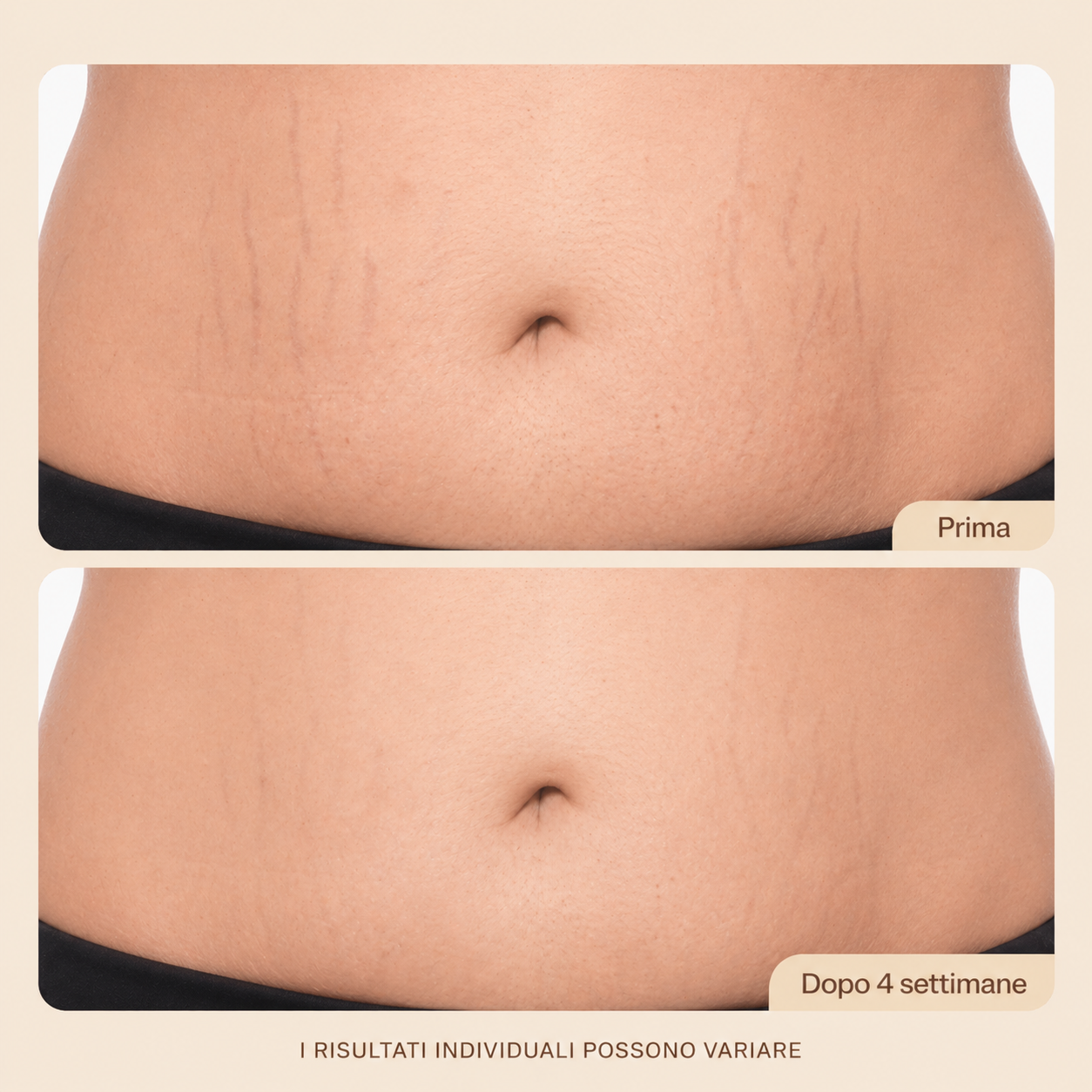 Crema Anti-Smagliature per il Ventre