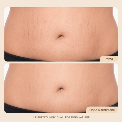 Crema Anti-Smagliature per il Ventre