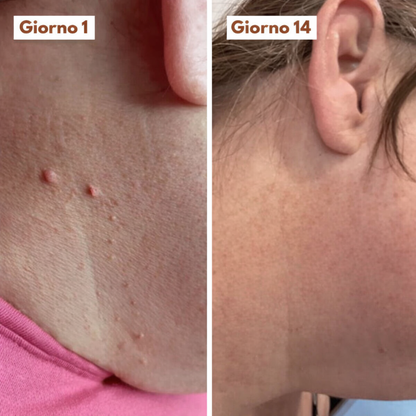 SkinClear Pro™ – Addio agli acrocordoni