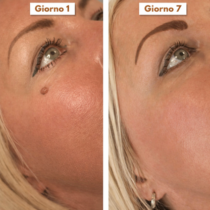SkinClear Pro™ – Addio agli acrocordoni