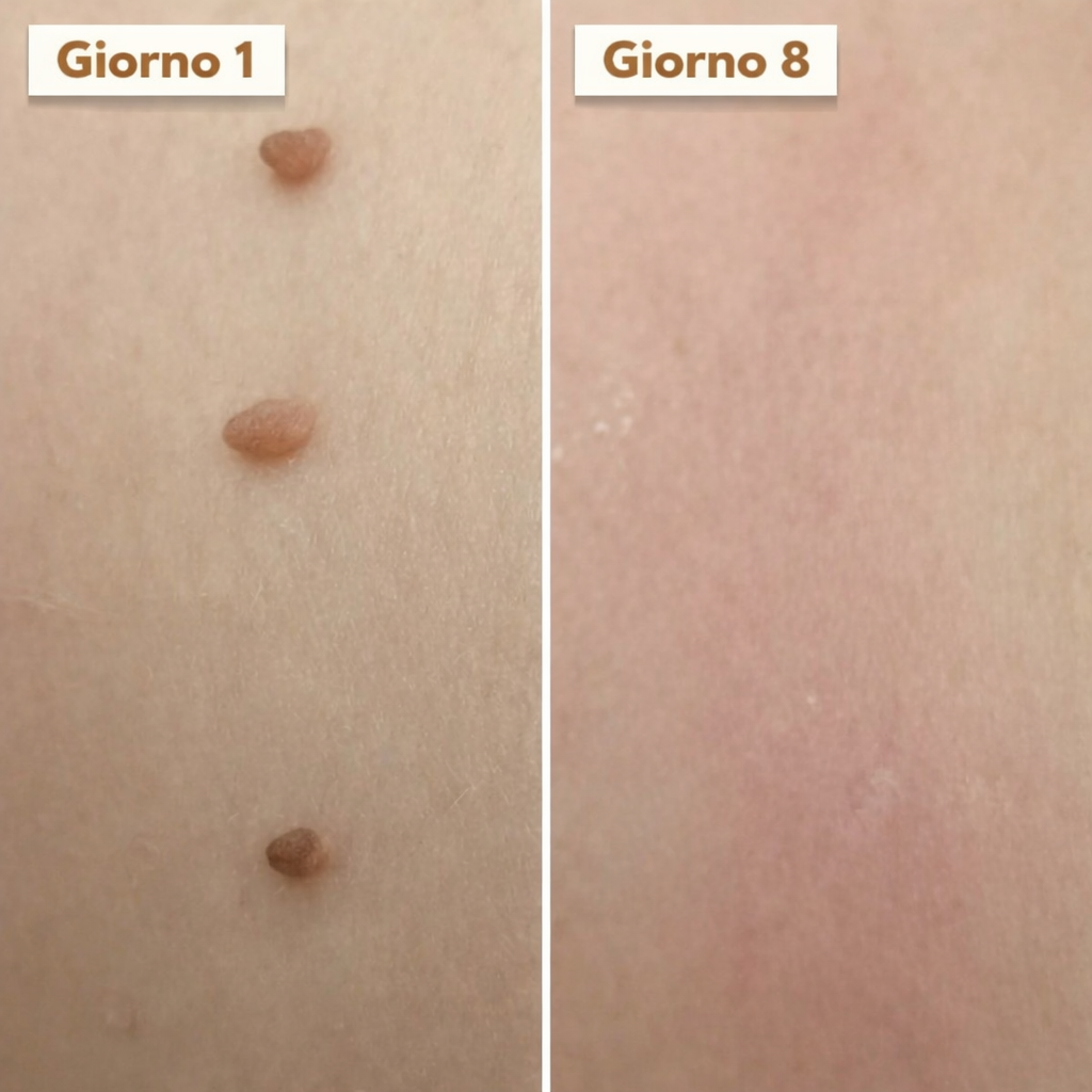 SkinClear Pro™ – Addio agli acrocordoni