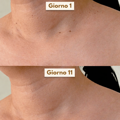 SkinClear Pro™ – Addio agli acrocordoni